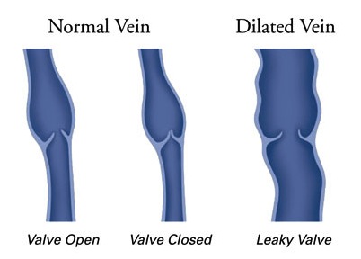 Normal and Dialated Veins